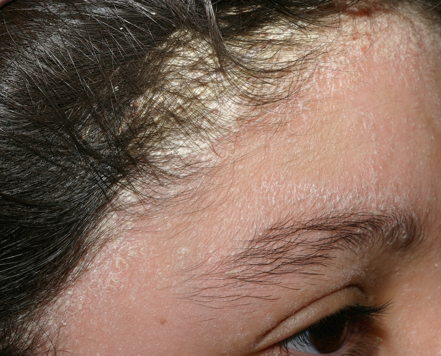 Псориаз волосистой части головы – лечение псориаза головы – симптомы и причины псориаза на голове - клиника «доктор волос»