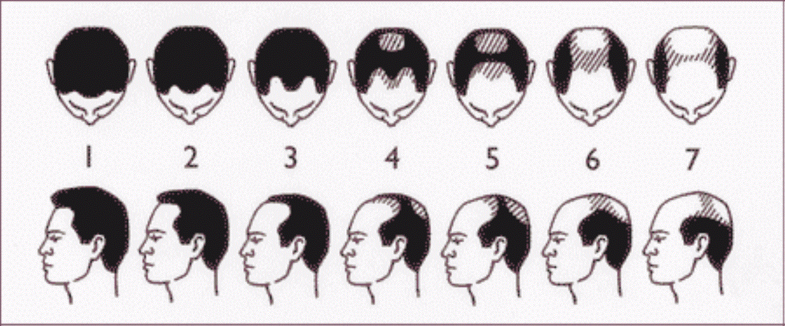 Выпадение волос у мужчины [причины и что делать]