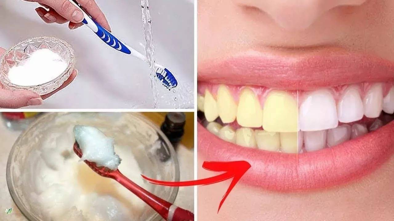 можно сделать отбеливание зубов