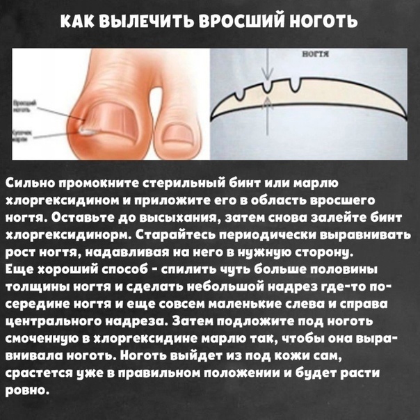 Болит большой палец на ноге сбоку около ногтя: что делать, если опух и покраснел