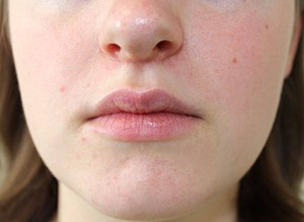 Как убрать морщины вокруг губ?