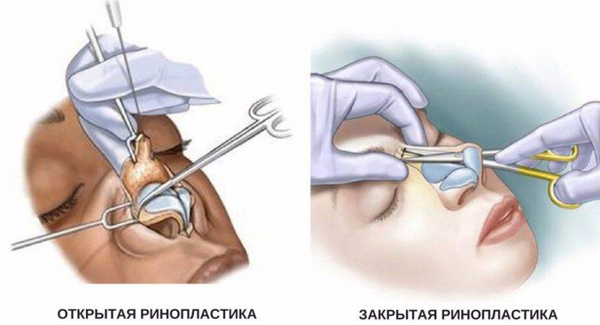 Ринопластика лица: описание видов процедуры, основные этапы проведения операции, реабилитационный период