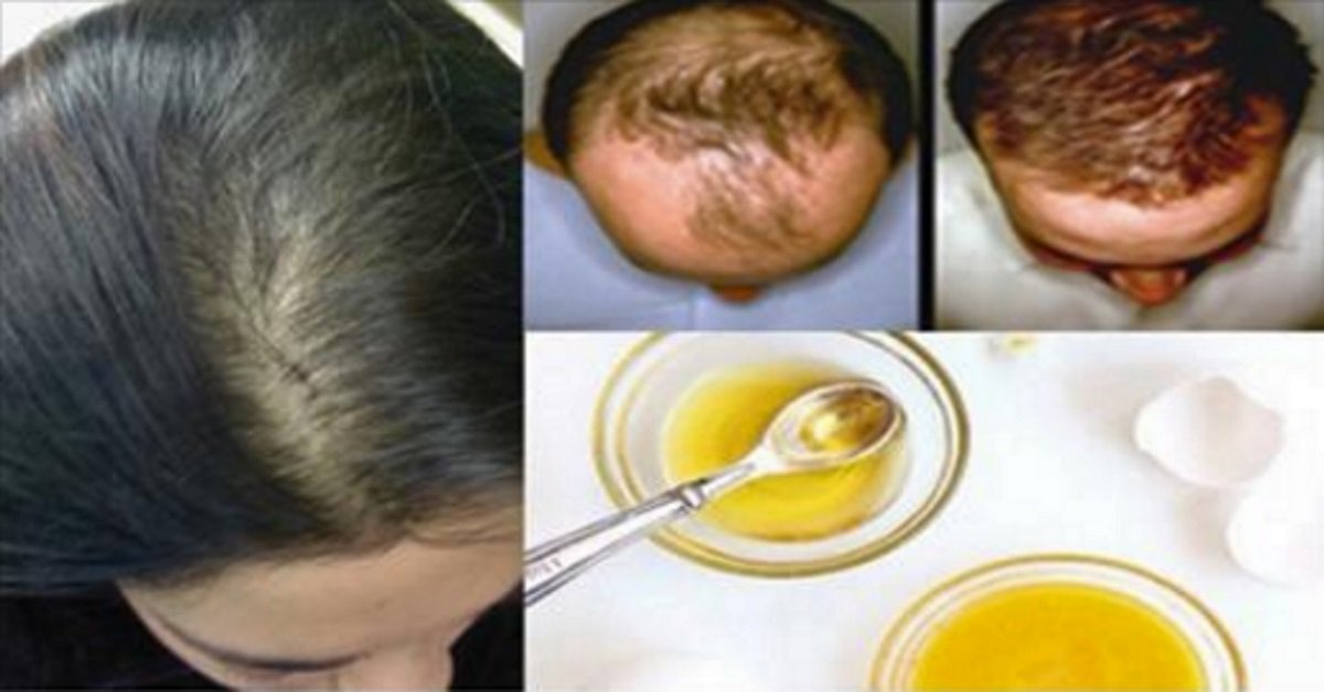 Как лечить выпадение волос у женщин медикаментозное лечение
