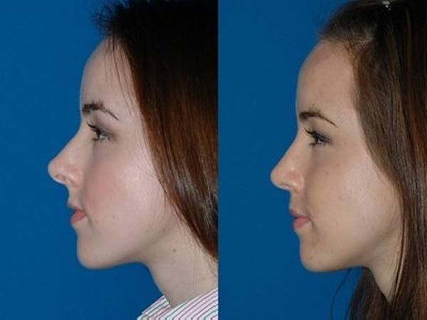 Курносый нос у девушки. Как исправить, фото до и после ринопластики