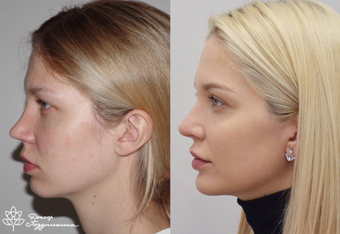 Клиника нос операция. Ринопластика. Пластика носа. Ринопластика носа. Повторная ринопластика фото до и после.