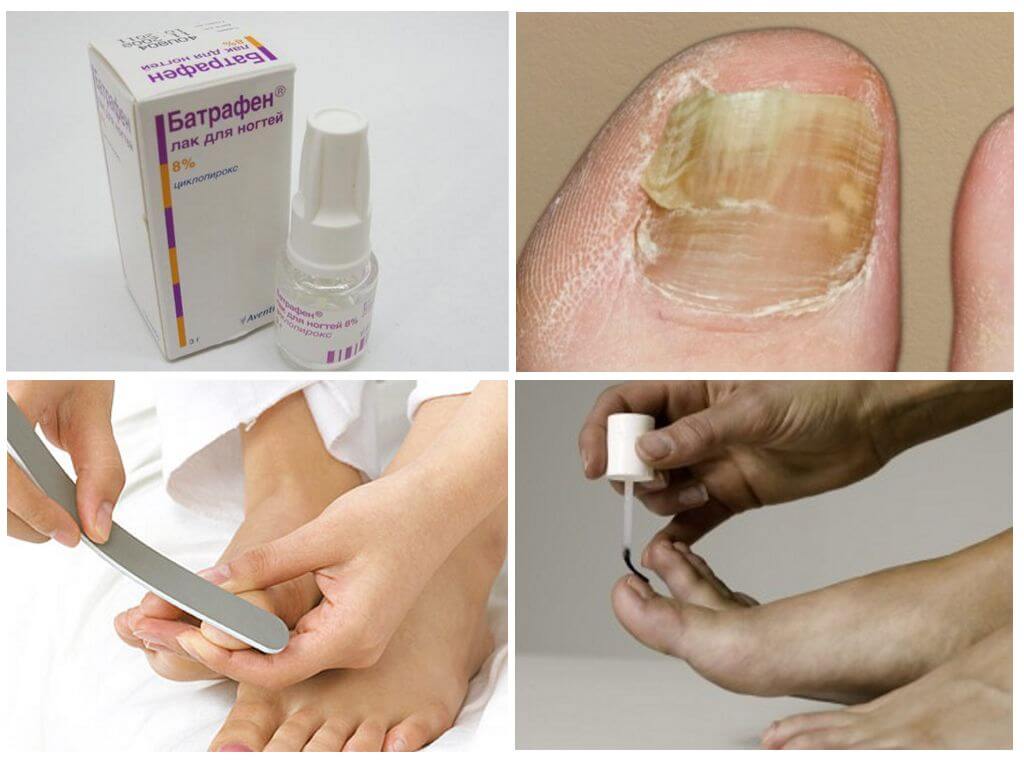 Как быстро вылечить грибок на ногтях рук: медикаментозное лечение и профилактические меры