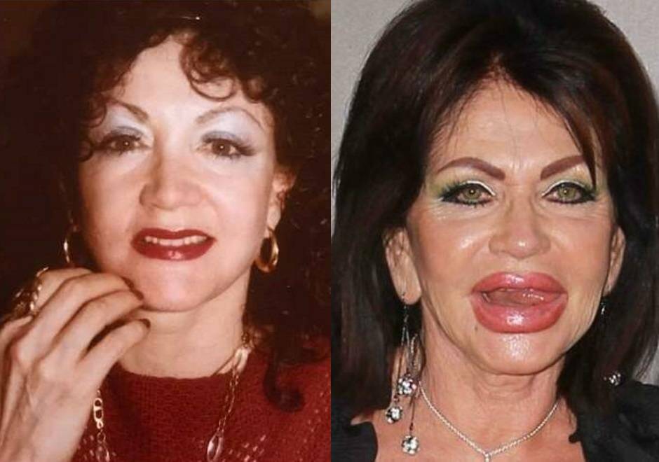 До и после: какими операциями увлекаются голливудские звезды