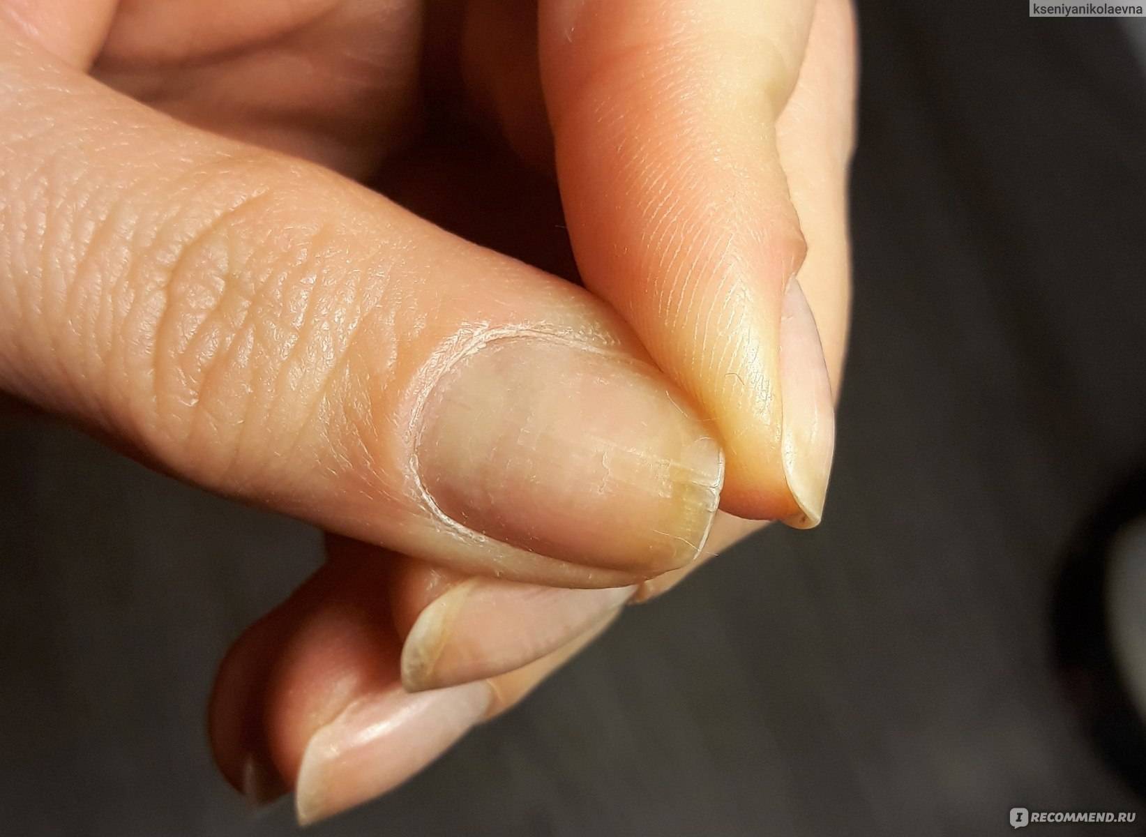 Лечение отслоения ногтевой пластины - подробное описание