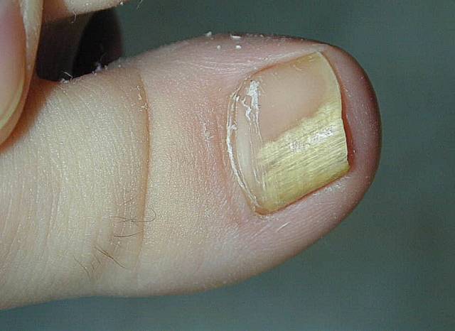 Изменение толщины ногтя