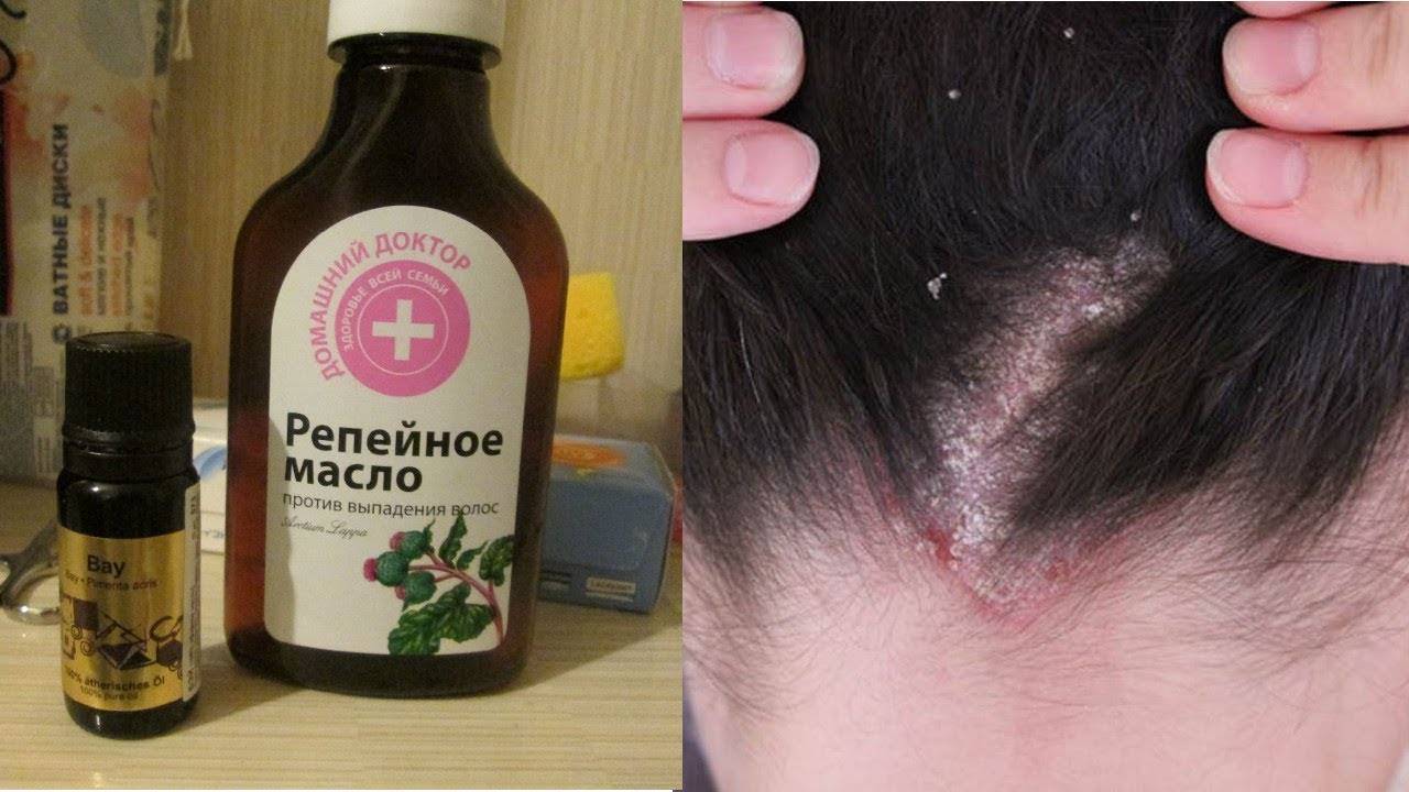 Лечение себореи кожи головы в домашних условиях: как вылечить заболевание применяя комплексный подход
