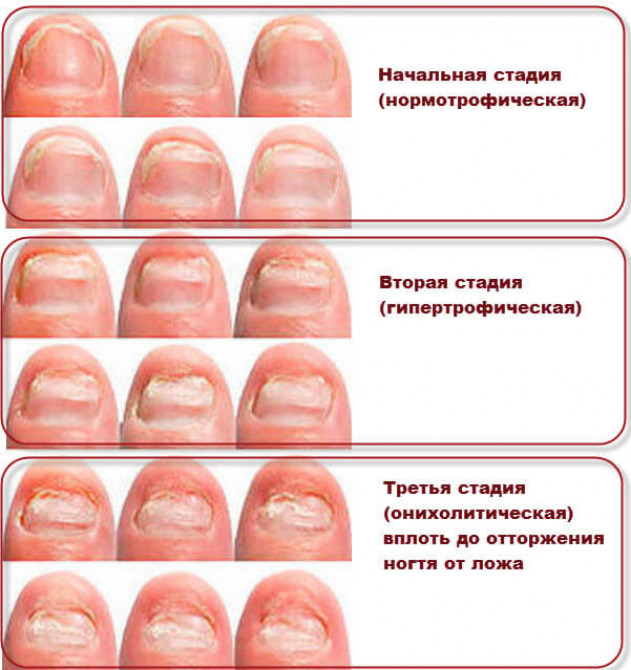 Темные пятна, линии на ногтях и под ногтями, причины, как лечить