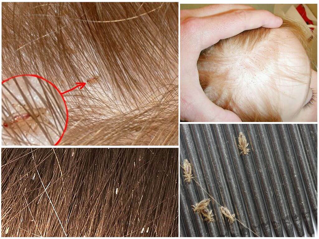 Как избавиться от гнид: как вывести на длинных волосах, как убрать сухие и мертвые гниды, удалить и убить быстро, как бороться с паразитами на голове, как лечить