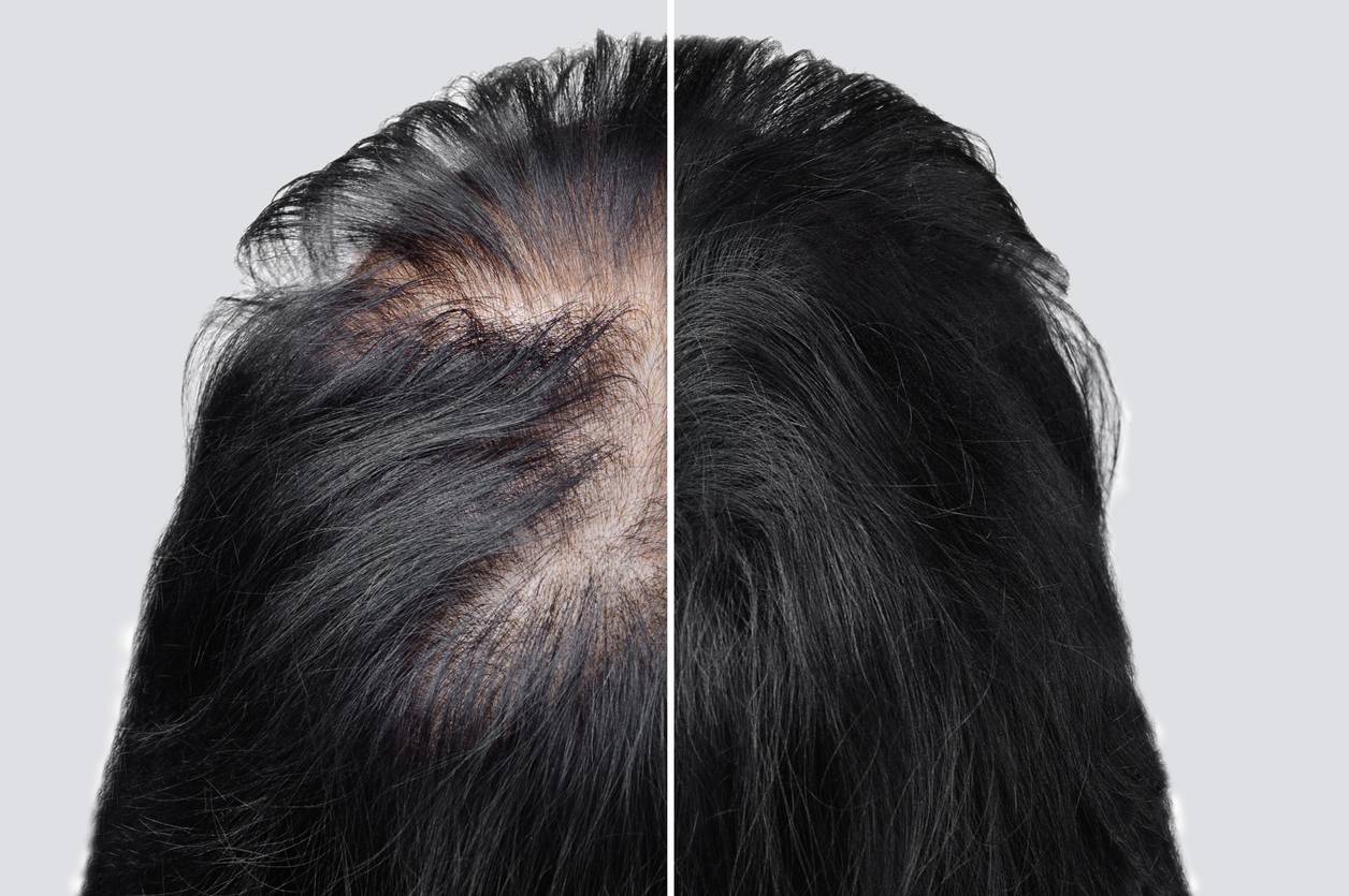 Выпадение волос (алопеция) - симптомы и лечение