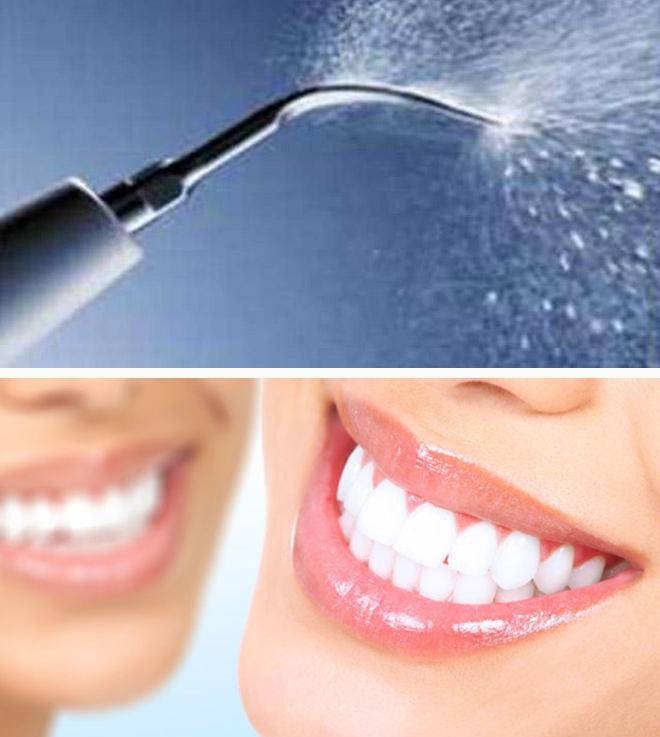 Чистка зубов air flow- дарим белоснежность улыбке
