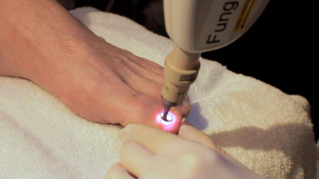 Лазерное лечение грибковых заболеваний ногтей - медицинский портал eurolab