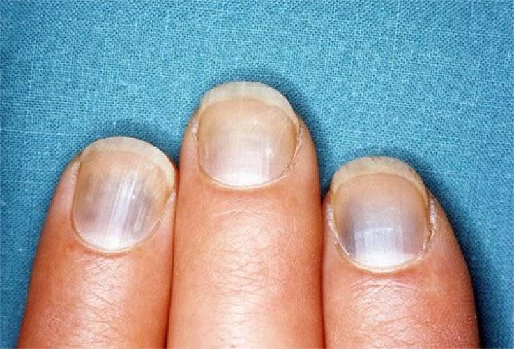 Почему синеют ногти на руках и ногах, основые причины