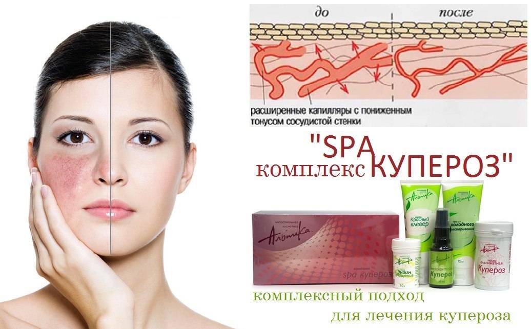 Купероз: причины заболевания и его профилактика, методы лечения