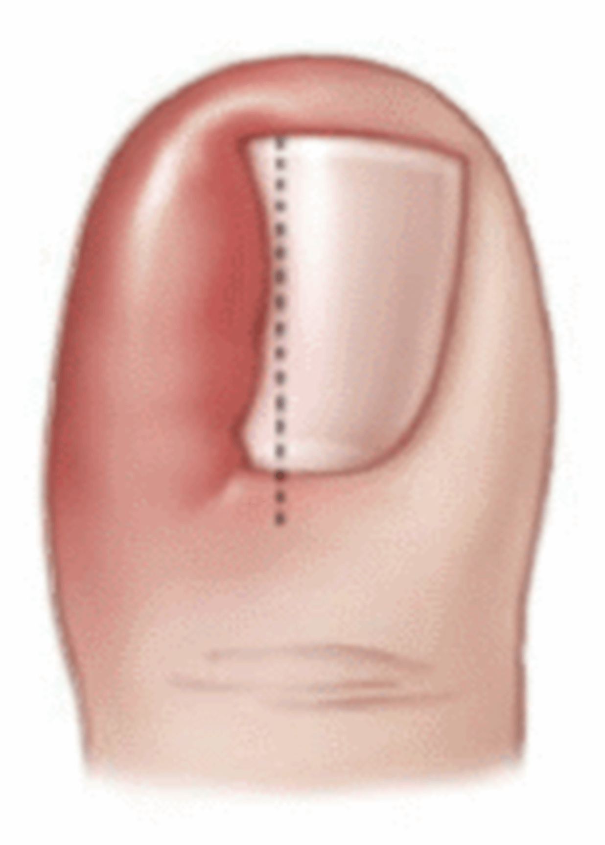 О процедуре с ногтями | memorial sloan kettering cancer center