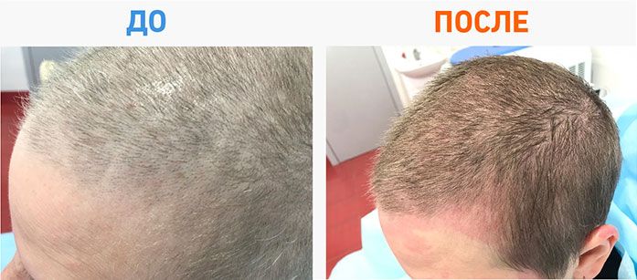 Как сохранить волосы при химиотерапии от выпадения? всегда ли после химиотерапии выпадают волосы? | клиники «евроонко»