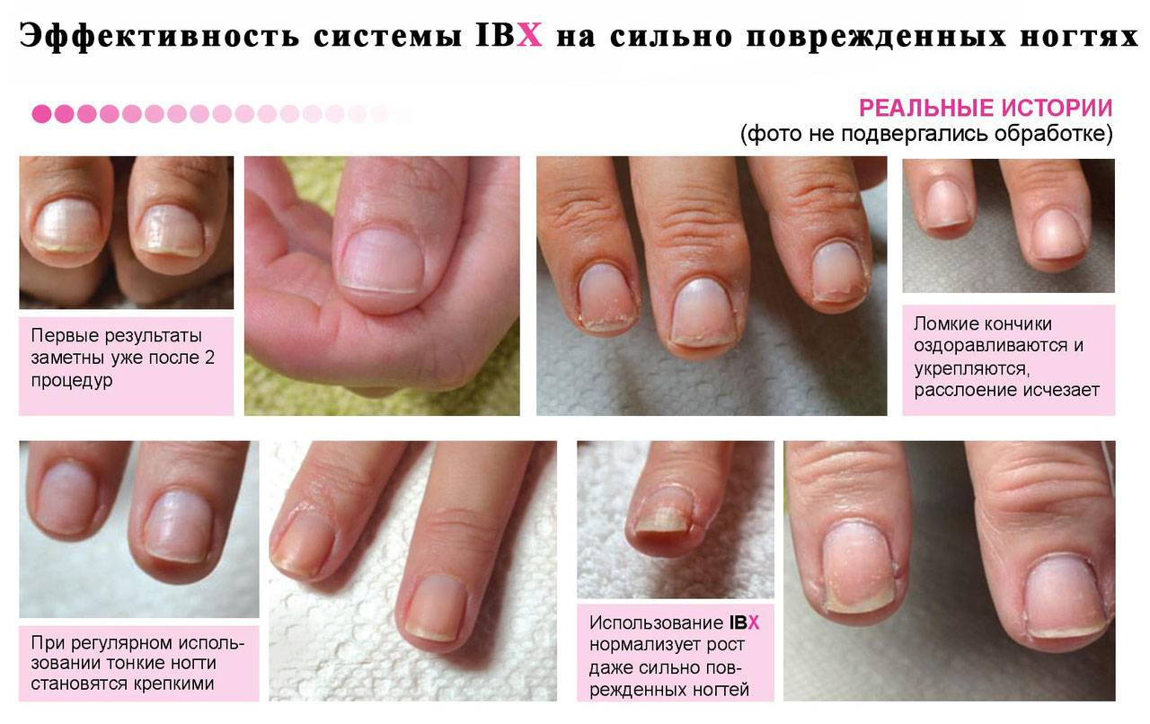 Восстановление ногтей после гель лака
