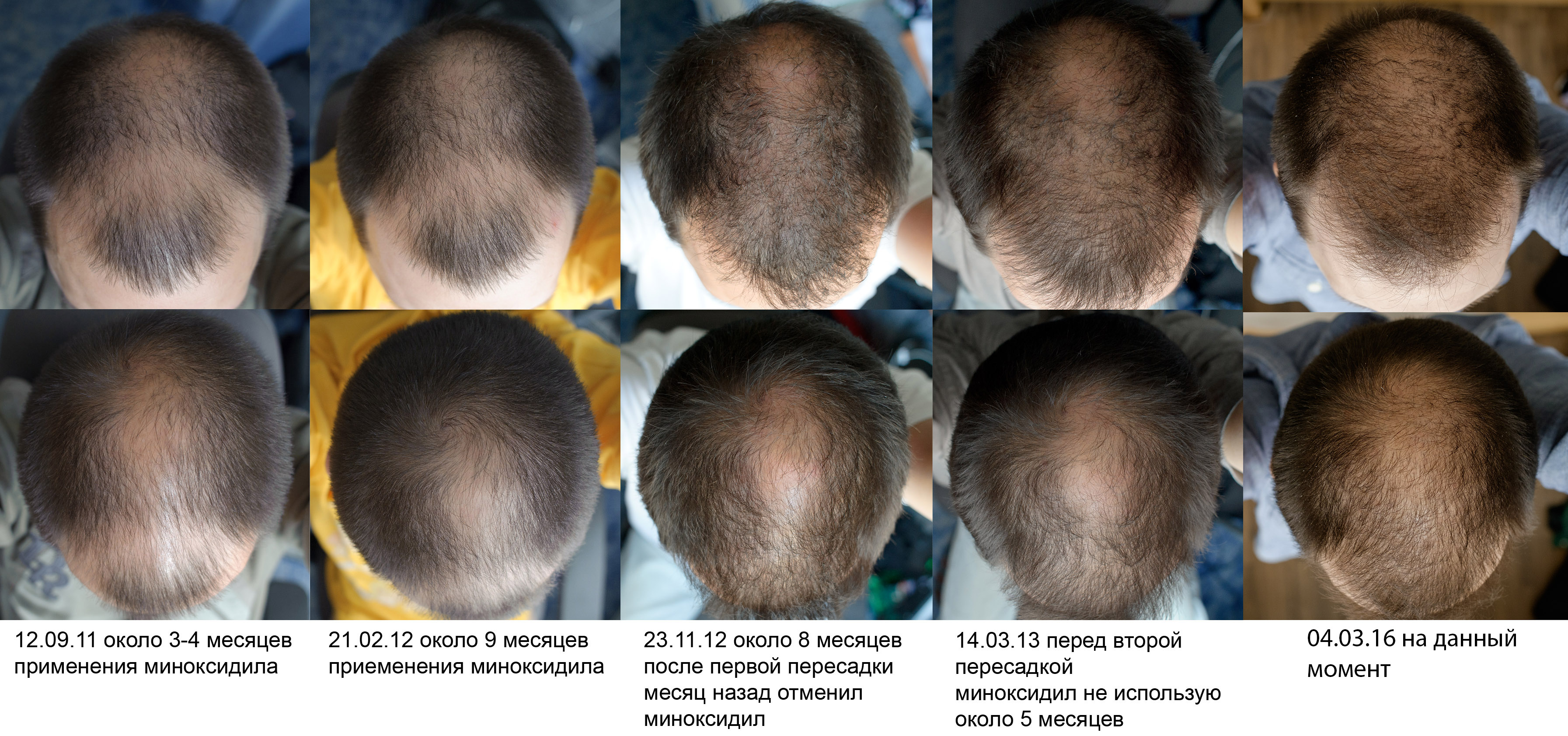 Как остановить выпадение волос после химиотерапии? способы восстановления