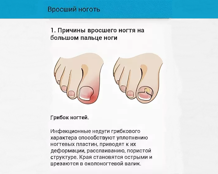 Что делать с вросшим ногтем: причины и профилактика вросших ногтей