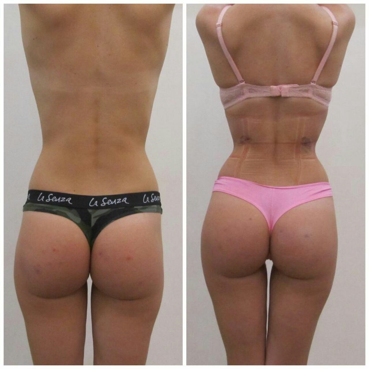 Thigh Lift Gallery - Before and After