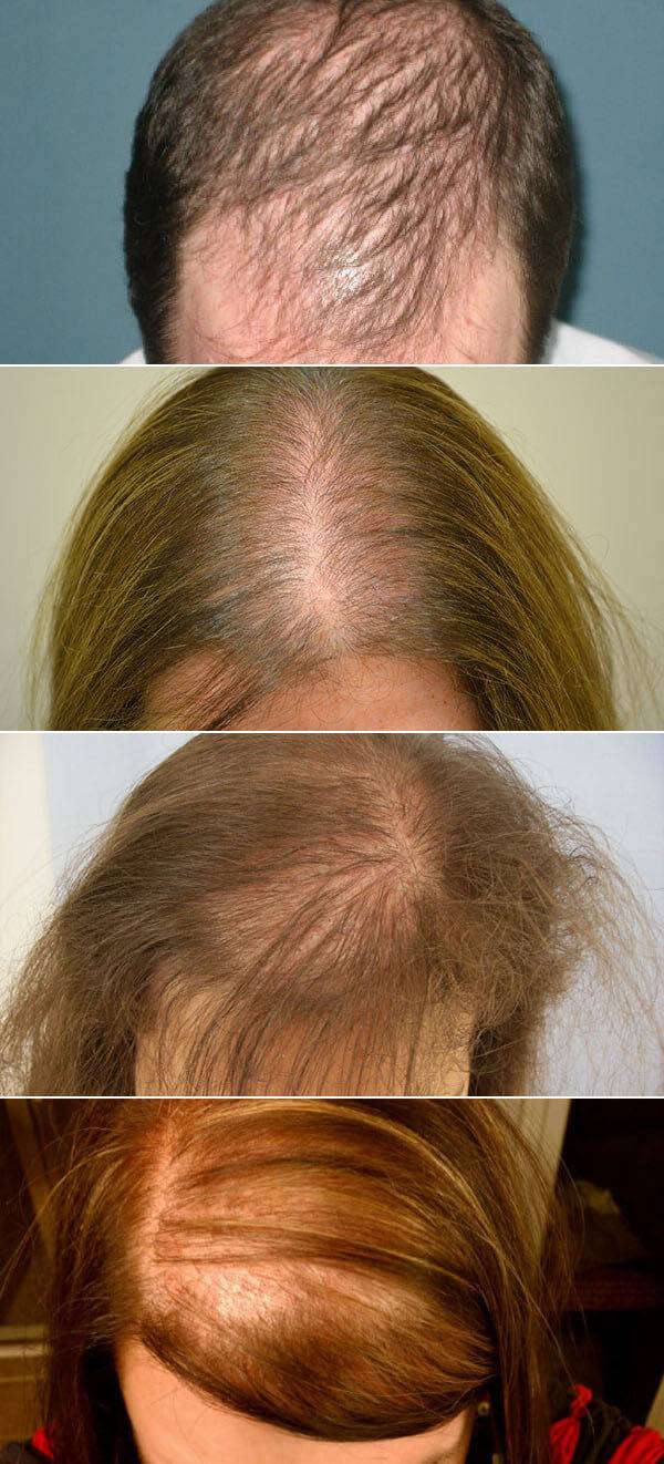 Можно ли полностью восстановить волосы при андрогенном выпадении