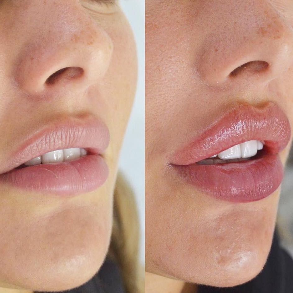 Контурная пластика губ: фото фатальных ошибок и рекомендации, как все сделать правильно.