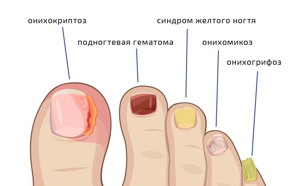 Грибок ногтей, лечение. причины и симптомы грибка ногтей.