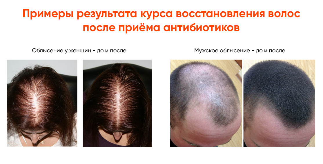 Средства от выпадения волос (шампуни, гели, таблетки, лосьоны) - рейтинг лучших