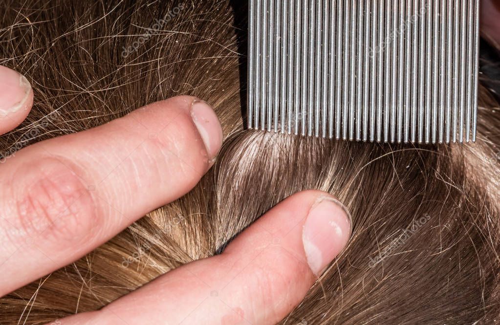Как отличить чешуйки перхоти от гнид на волосах: размер, локализация, степень дискомфорта