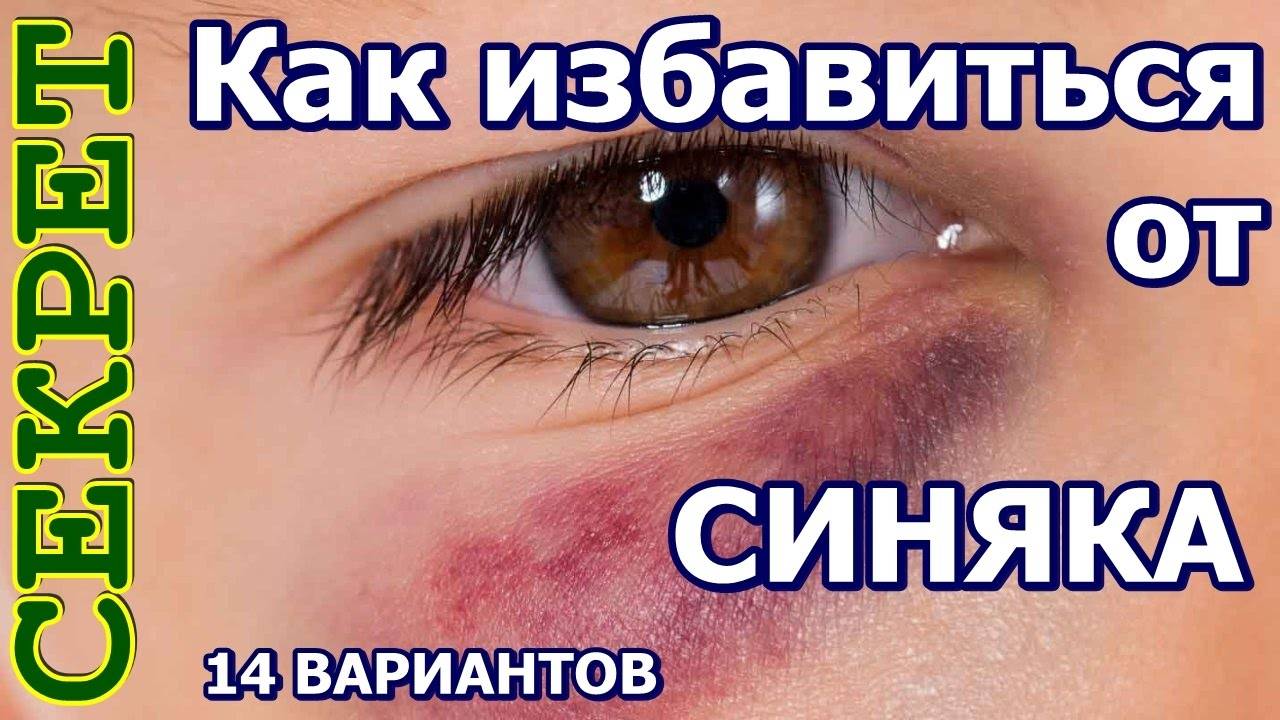 Как убрать синяк под глазом от удара: за 1 день в домашних условиях