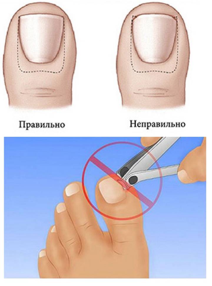 Лечении вросшего ногтя - медцентр "диагност"